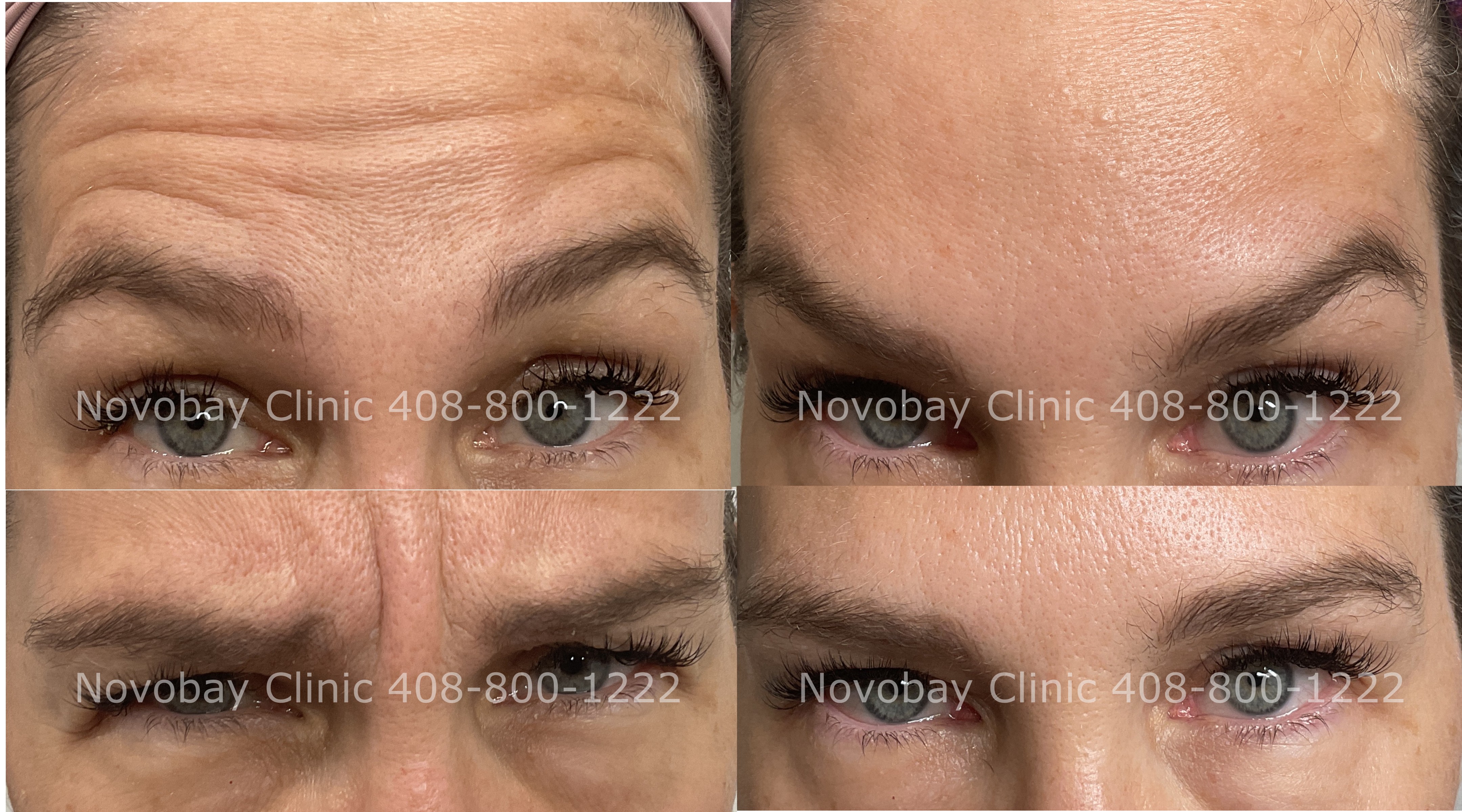 Wrinkle relaxers before and after