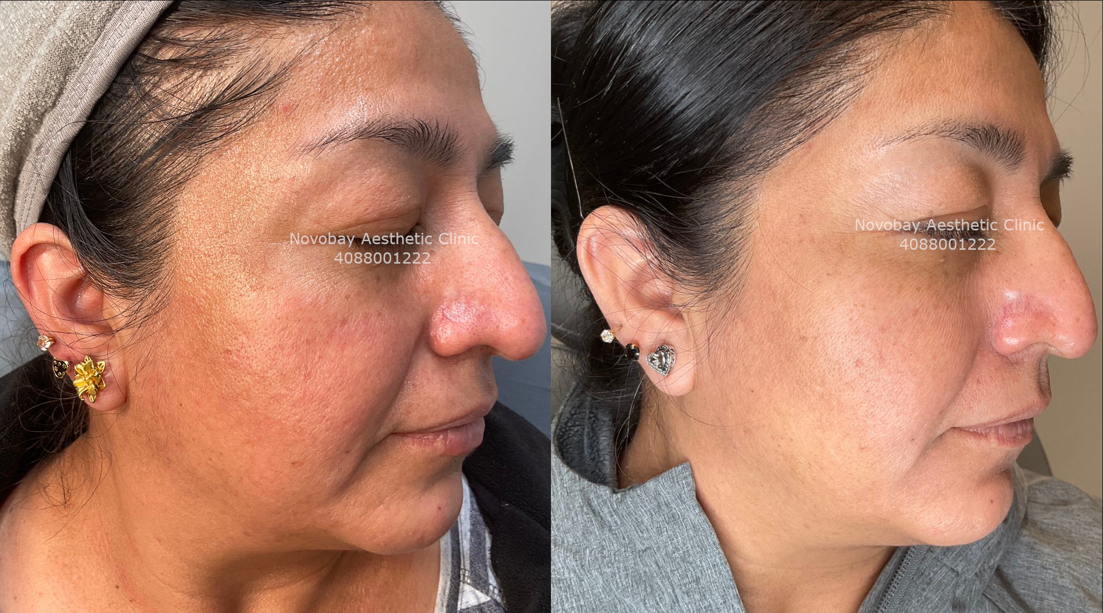 Microneedling before and after